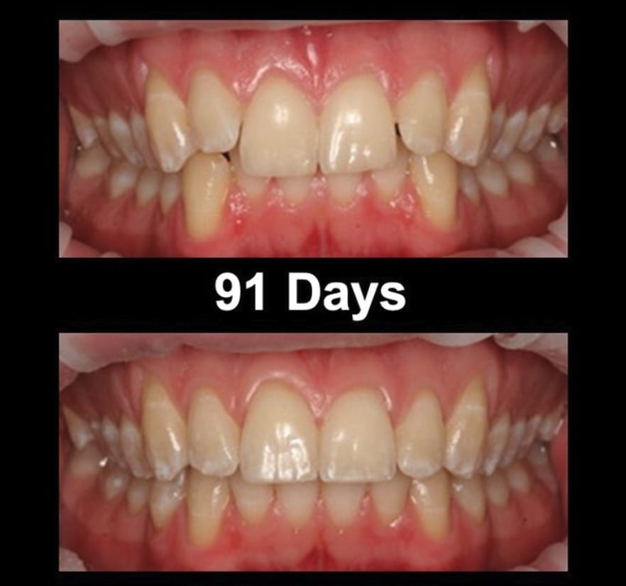 Before and after FASTBRACES in 91 days