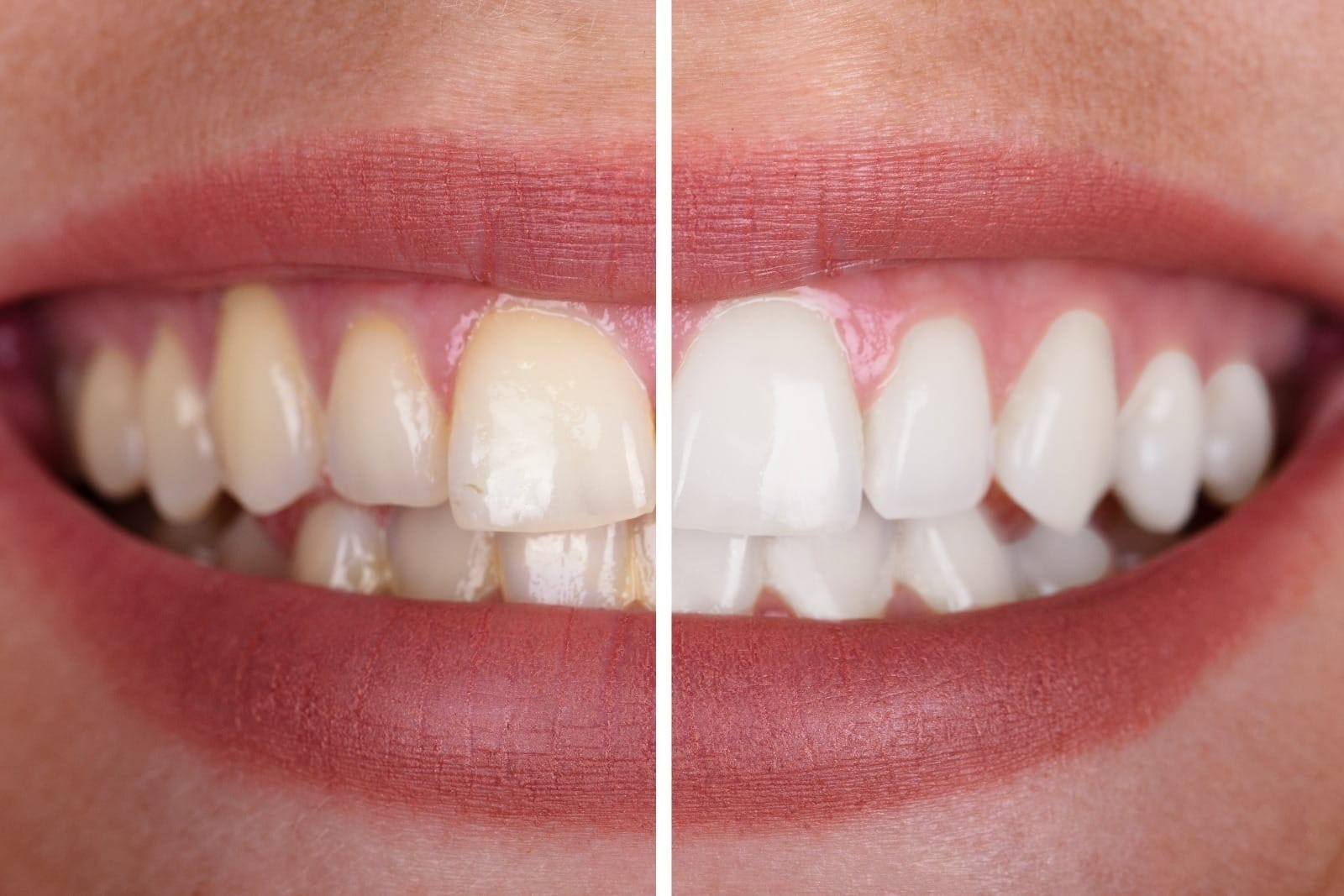 Before and after of teeth whitening cosmetic dentistry at Progressive Dental.